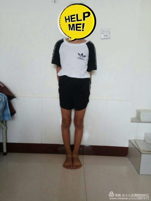 罗圈腿会不会遗传罗圈腿是遗传病吗？(o型腿会遗传给下一代吗）