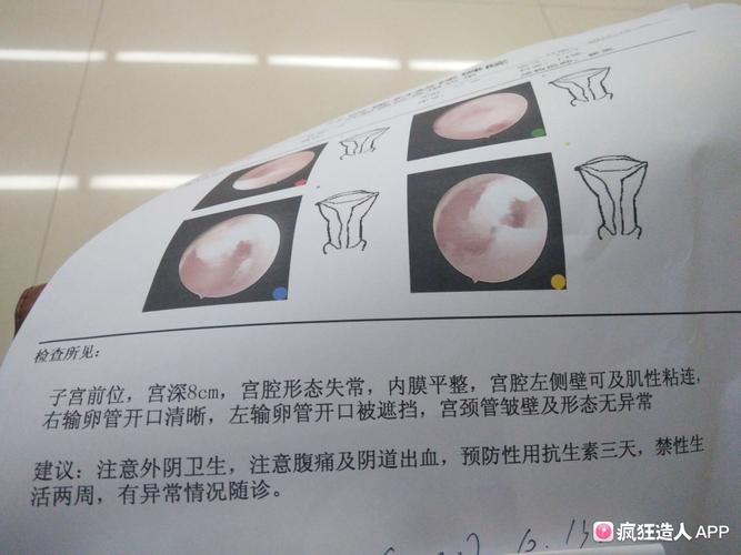 轻度宫腔粘连可以怀孕吗(宫腔粘连最明显的症状）