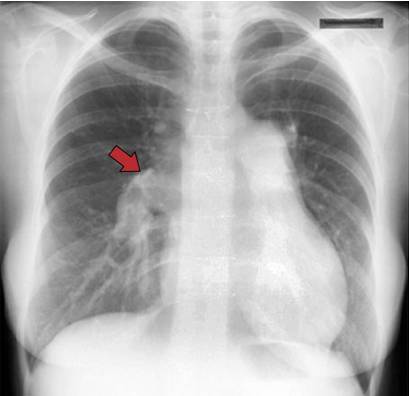 胸片多久后可以怀孕(拍胸片第二个月怀孕有伤害吗)