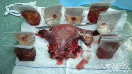 腺肌症子宫多大算严重(子宫全切后变年轻了）