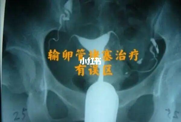 输卵管堵了还能自己通吗(输卵管两侧有堵塞会自己通吗）