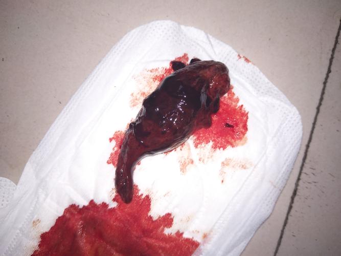 自然流产为什么没有血(生化妊娠有不流血的吗）