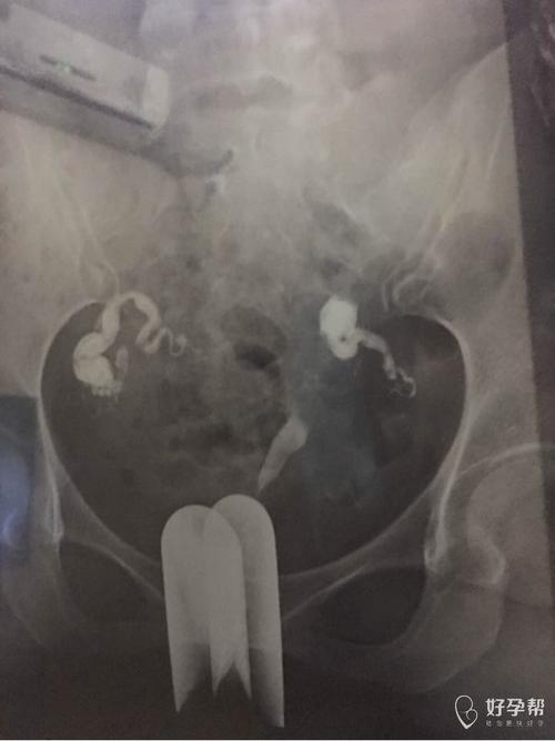 输卵管积水可以备孕吗(输卵管积水粘连还可以怀孕吗）