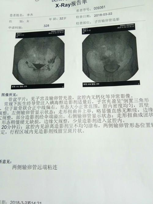 输卵管伞端粘连有救吗(输卵管伞端不通严重吗）