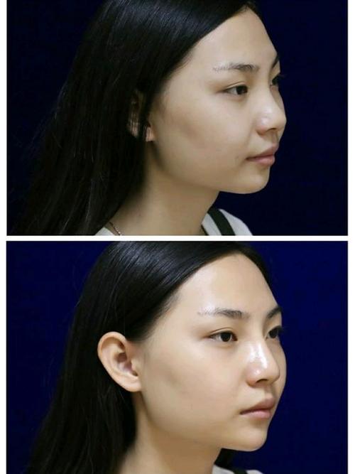 隆鼻之后多久可以怀孕(做完隆鼻手术两个月后怀孕）