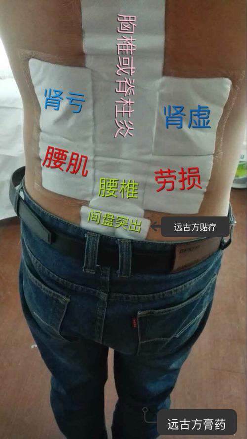 腰肌劳损可以怀孕吗(备孕期间腰肌劳损怎么办）