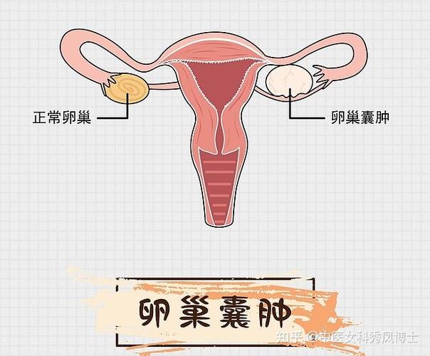 附件囊肿会自己消失吗(女性左侧附件囊肿如何治疗）