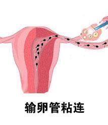 输卵管粘连能治好吗(少了一个输卵管的危害)