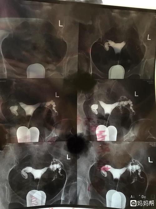输卵管粘连手术后还会粘连吗(输卵管粘连手术视频过程）