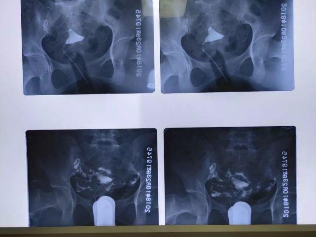 输卵管造影后多久可以同房(输卵管造影17天可以同房吗）