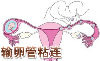 输卵管粘连想怀孕，该怎么办？(输卵管粘连怎么治）