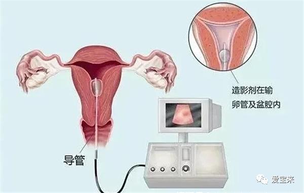 输卵管通水是什么意思(做通水还是造影好）