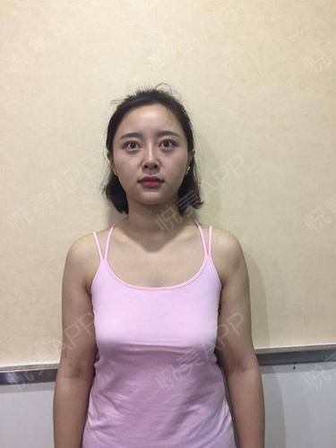 胸外扩是什么样子的(15岁胸型外扩是什么样子）