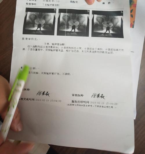 输卵管伞端粘连怎么治效果好(输卵管远端粘连如何治疗）