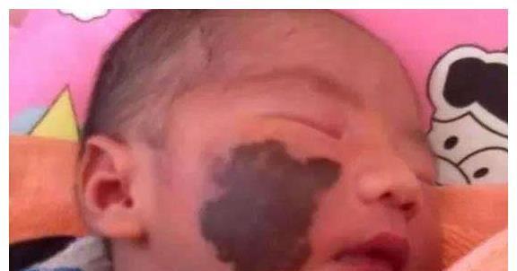 胸前有胎记代表什么(男人胸前有胎记好吗）