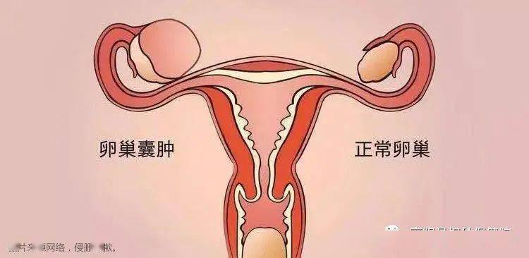 附件囊肿吃什么药会消(卵巢囊肿最怕三种运动）