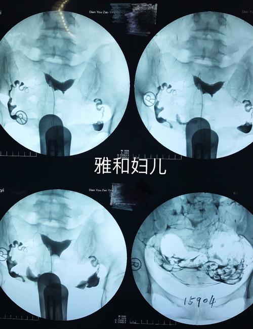 输卵管造影后多久可以要孩子(做输卵管造影术后悔了）
