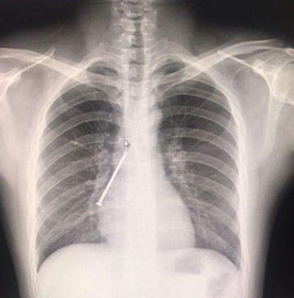 胸片做完多久可以怀孕(拍完胸片一个月后发现怀孕了）