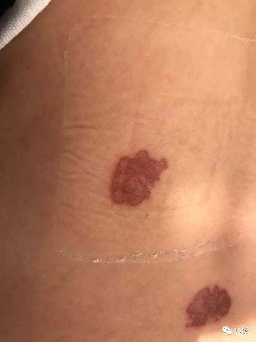 贴三伏贴皮肤过敏怎么办(贴三伏贴后起小疹子）