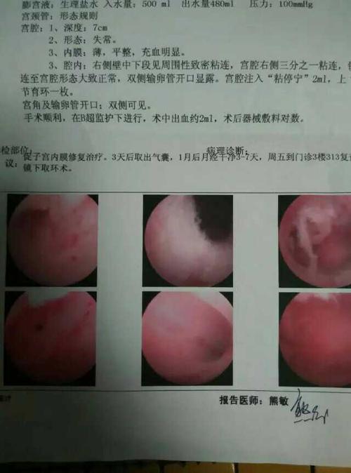 轻度宫腔粘连可以怀孕吗(宫腔粘连最明显的症状）