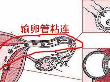 输卵管出现粘连是怎么回事？怎么才能怀孕呢？(输卵管粘连但是是通的）