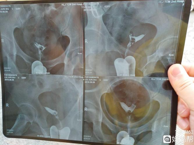 输卵管堵塞了能怀孕吗？想怀孕难？(输卵管双侧堵塞还能自然怀孕吗）