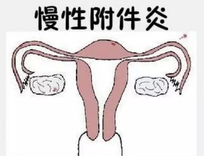输卵管炎是盆腔炎吗(慢性输卵管炎什么症状）