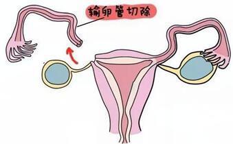 输卵管堵塞想要娃，选试管婴儿还是腹腔镜？(输卵管堵塞手术怎么做）