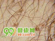 阴虱的潜伏期是多久不知不觉间你可以患上了阴虱！(阴虱在身体能潜伏多久）