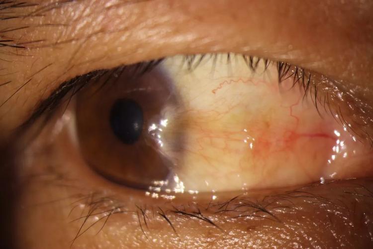 阴虱的潜伏期是多久不知不觉间你可以患上了阴虱！(阴虱在身体能潜伏多久）