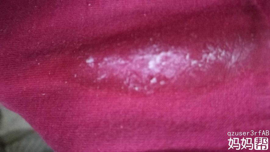 首先一般来说豆腐渣白带不是着床在子宫里