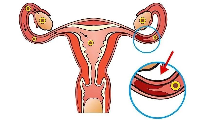 输卵管堵塞的症状(女人怎么会输卵管堵塞）