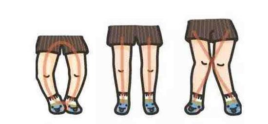 罗圈腿会不会遗传罗圈腿是遗传病吗？(o型腿会遗传给下一代吗）