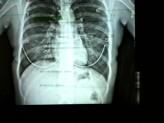 胸片做完多久可以怀孕(拍完胸片一个月后发现怀孕了）