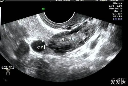 输卵管系膜囊肿怎么引起的(输卵管系膜囊肿怎么治疗）
