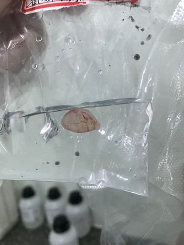 输卵管系膜囊肿是什么(输卵管系膜囊肿手术）