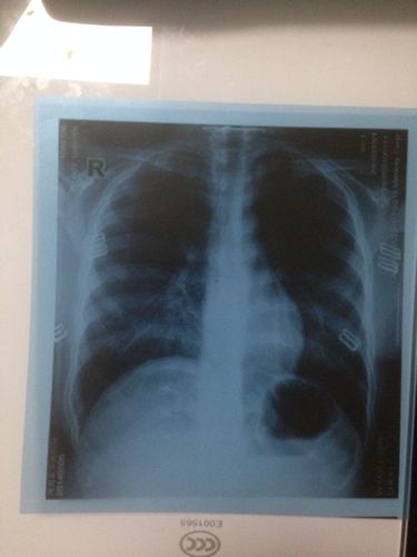 胸片后多久可以怀孕(拍完胸片一周后怀孕了）