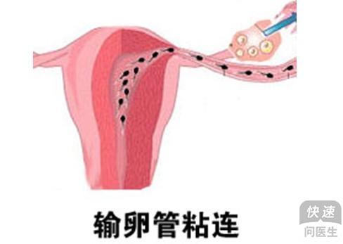 输卵管粘连怎么治最好(吃中药输卵管居然通了）
