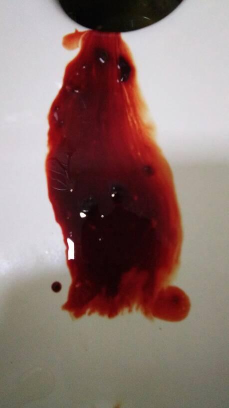 非经期出血是什么原因(非经期下面出血鲜红色）