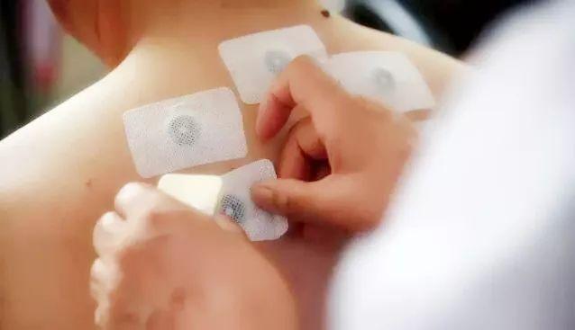 贴三伏贴能吃炸鸡吗(贴了三伏贴能吃炸串吗）