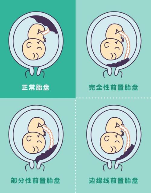 胎盘为什么会粘连(胎盘粘连常见吗）