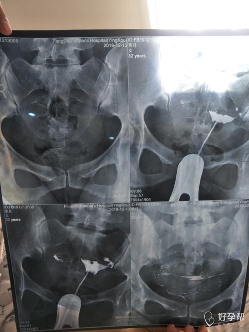 通水可以疏通输卵管吗(输卵管一般要通几次）