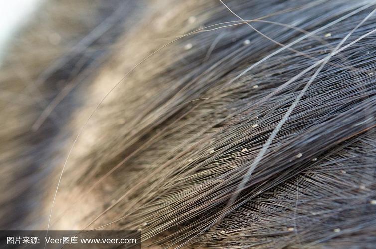 阴虱的虫卵藏在哪里阴虱卵真的在毛囊里吗？(阴虱卵是在毛囊里面吗）