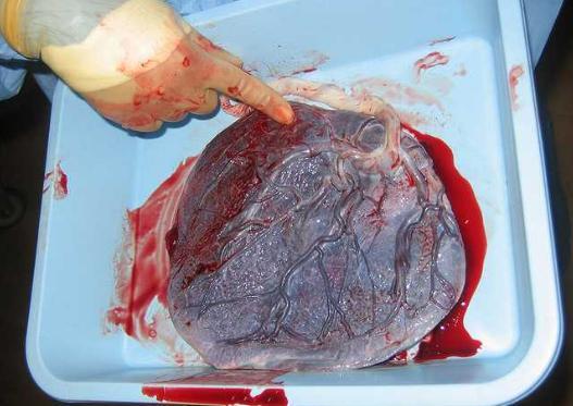 凶险性前置胎盘什么时候最危险(胎盘血池孕妇要注意什么)