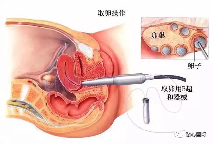 取卵取得多和试管成功率有关系吗?(取卵6个成功率怎么样)