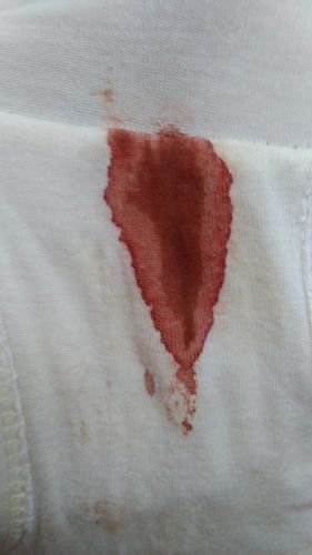 什么人容易排卵期出血(排卵期出血4大症状）