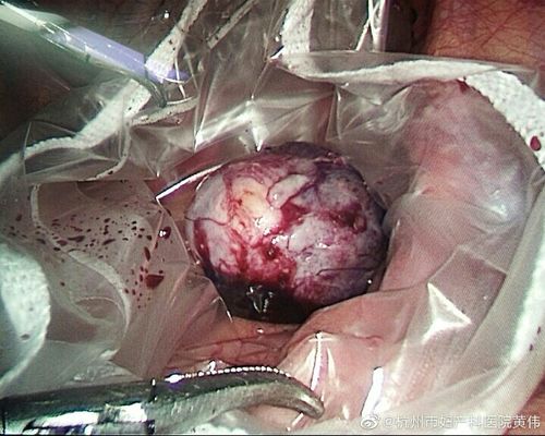 为什么会得畸胎瘤(畸胎瘤是什么东西）