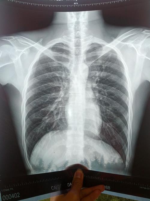 做x胸片多久可以怀孕(拍片子后多久可以怀孕）