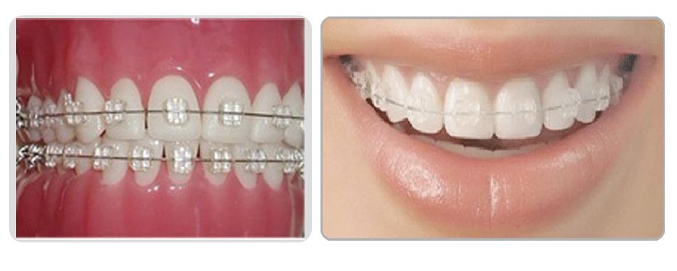 做瓷托槽可以怀孕吗(怀孕身上的肉瓷实了好吗）