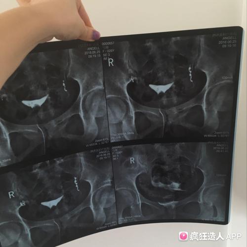 做x胸片多久可以怀孕(拍片子后多久可以怀孕）